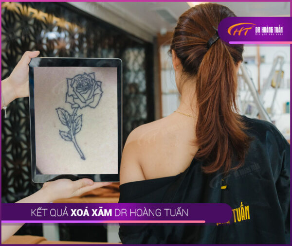 xoá xăm bằng laser có hết không?